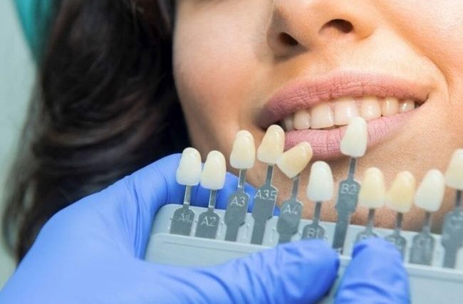 Wybielanie zębów – poznaj najczęściej powtarzane mity na ten temat!