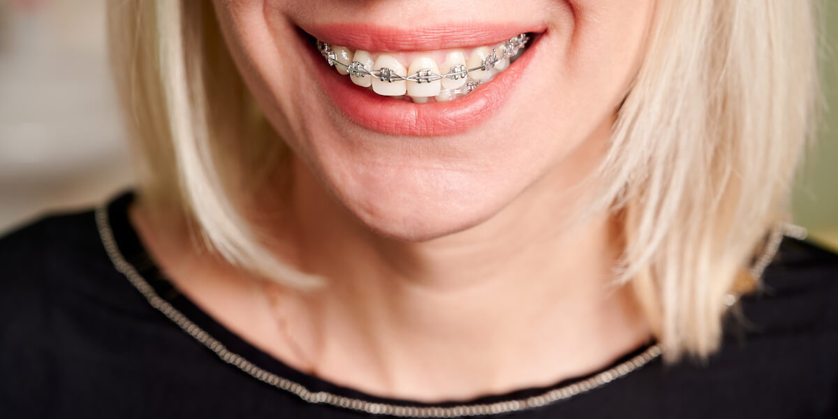 Leczenie wady zgryzu aparatem nakładkowym czy stałym – co będzie lepsze?